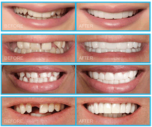 Smile design with Veneers and Laminates 1